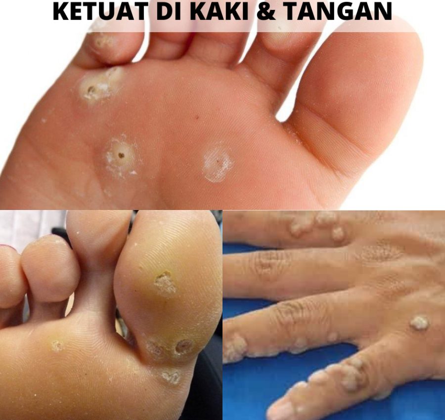 KETUAT-KAKI-TANGAN-1.png