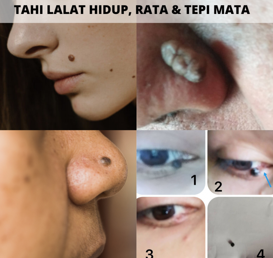 KETUAT-KAKI-TANGAN-3.png