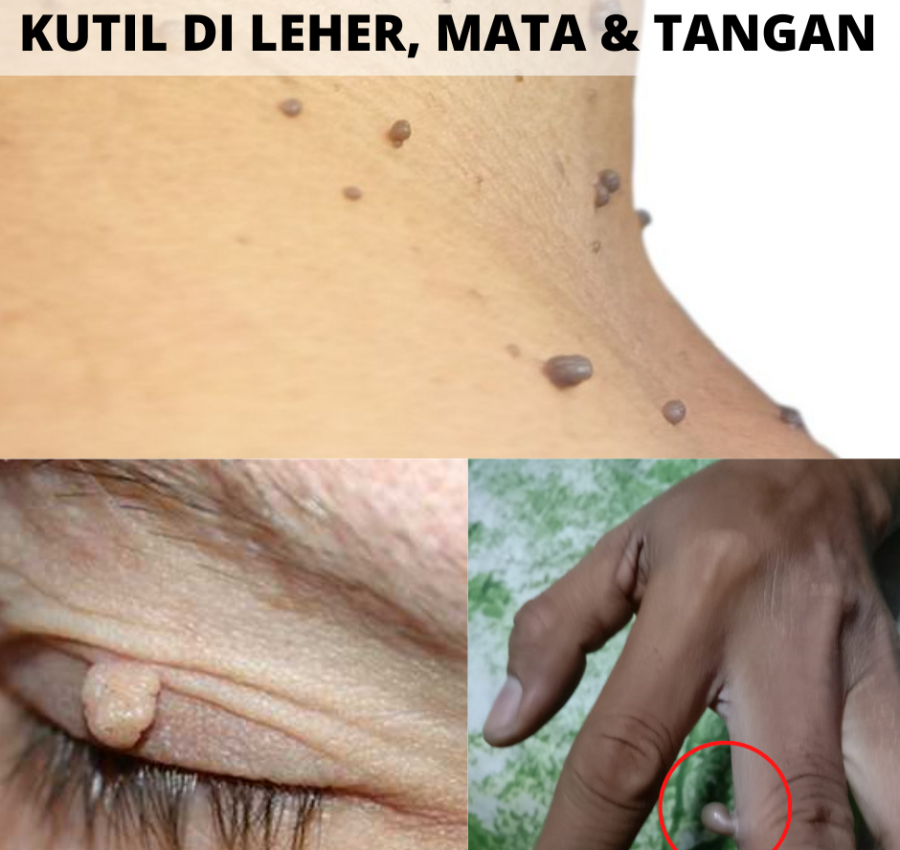 KETUAT-KAKI-TANGAN-5.png